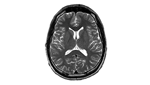 brain study from siemens sempra